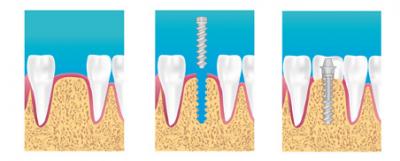 implant dentaire dentiste noisy le sec