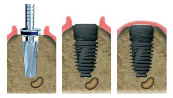 pose implant dentaire dentiste noisy le sec